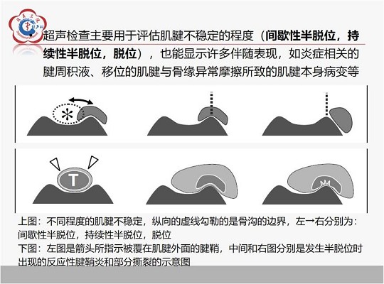 【经典超声书籍解读】肌肉骨胳超声诊断之肌腱不稳、退行性病变及肌腱撕裂