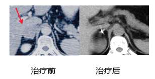 卓越的肿瘤杀手--射波刀