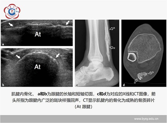 【经典超声书籍解读】肌肉骨胳超声诊断之肌腱病与部分撕裂