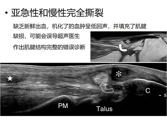 【经典超声书籍解读】肌肉骨胳超声诊断之肌腱完全撕裂和术后改变