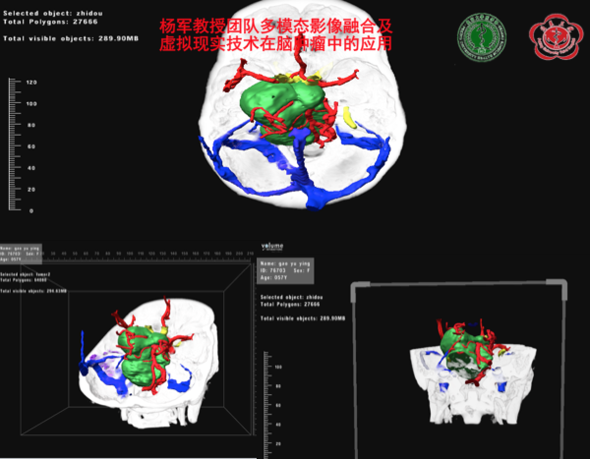 虚拟现实技术在颅底肿瘤中的应用