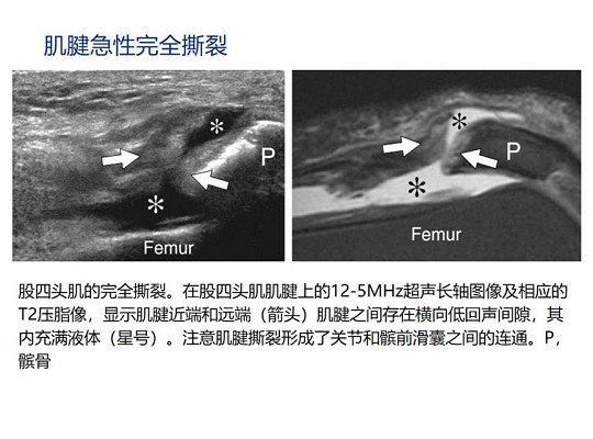 【经典超声书籍解读】肌肉骨胳超声诊断之肌腱完全撕裂和术后改变