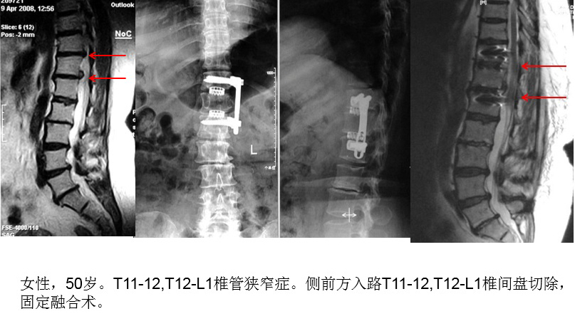 脊柱组典型病例 