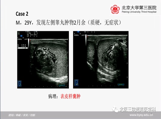 病例回顾与学习之睾丸畸胎瘤