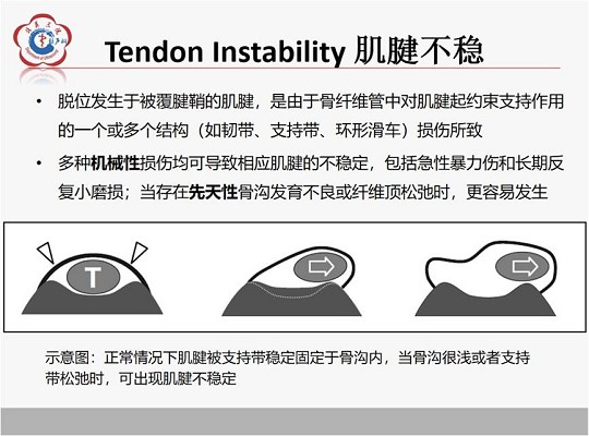 【经典超声书籍解读】肌肉骨胳超声诊断之肌腱不稳、退行性病变及肌腱撕裂