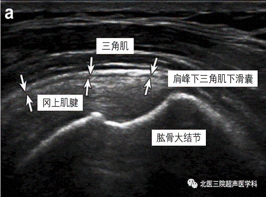 滑囊的超声评估-解剖及常见病变（一）