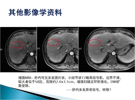 第三届中国超声造影大会病例大赛北医三院超声科获奖病例展示（二）