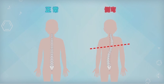 孩子站的时候总歪着，坐姿也不正，怎么纠正也改不了，长大就能好吗？