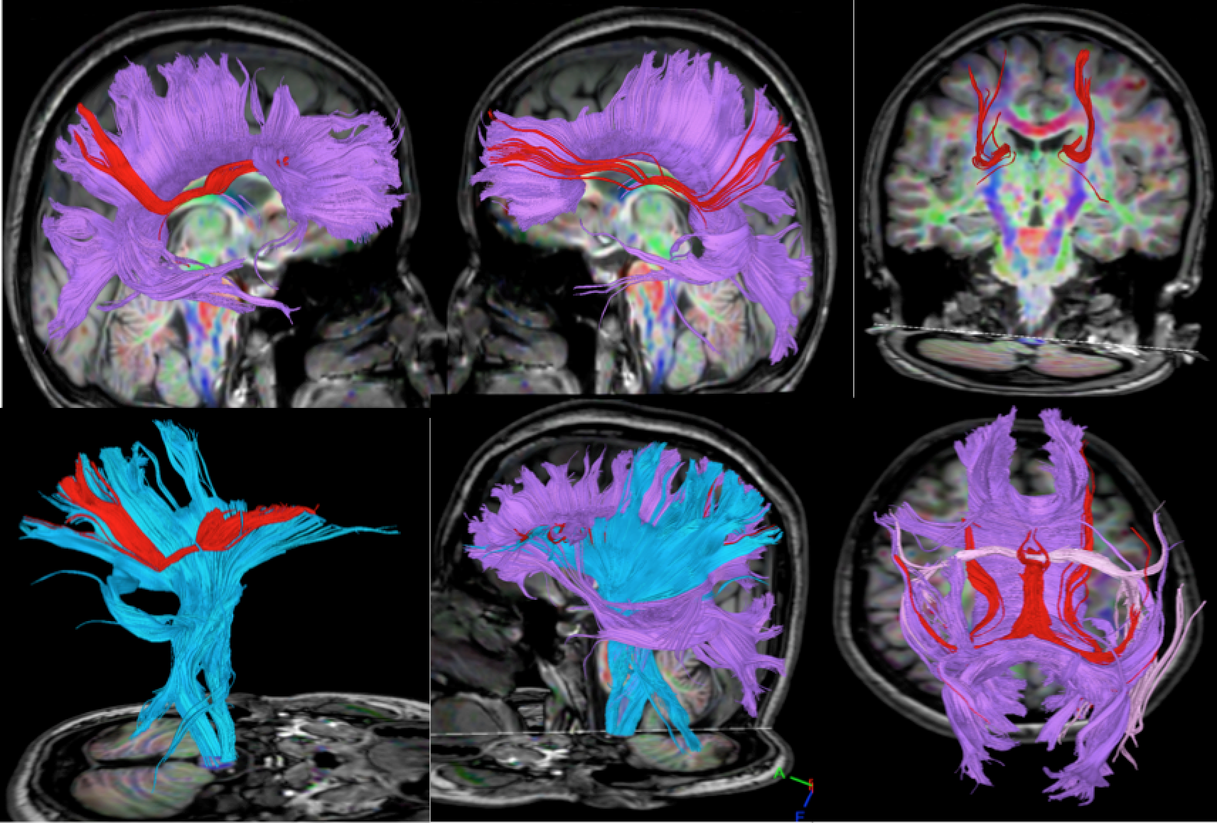神经系统疾病的DTI评估