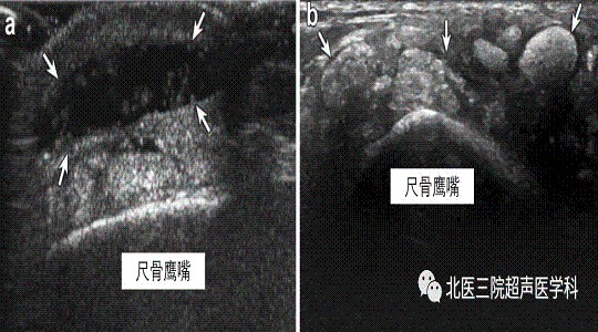 滑囊的超声评估-解剖及常见病变（二）