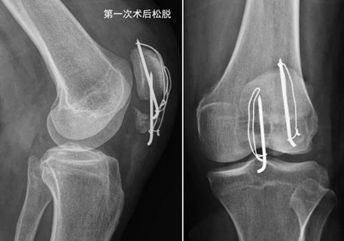 异形垫片，纵横连接——髌骨下极粉碎骨折的新选择