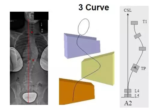 北医三院康复科引进Schroth三维脊柱侧弯治疗法治疗脊柱侧弯患者