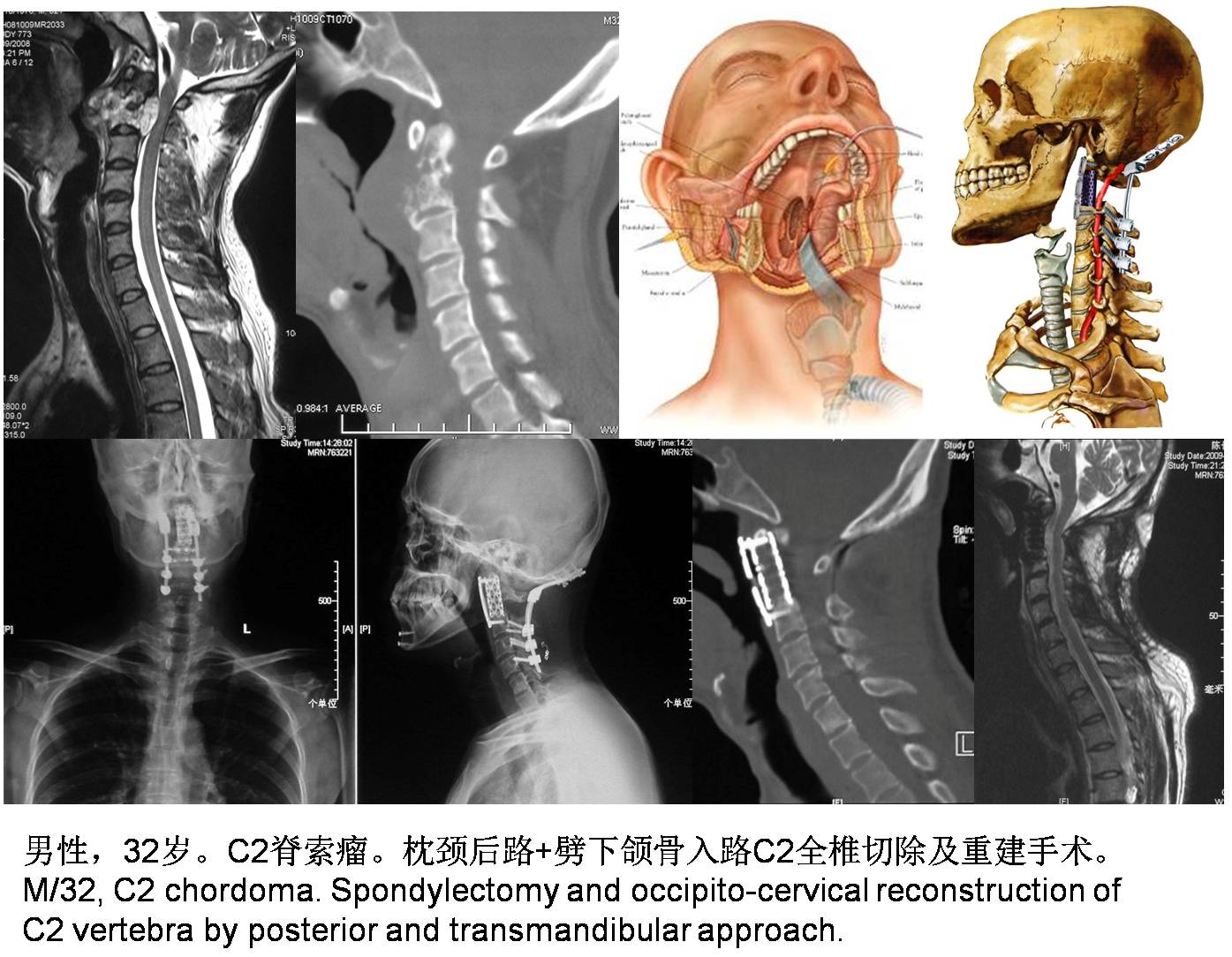 脊柱组典型病例 