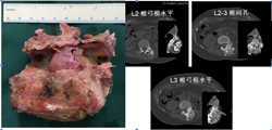 从3个病例谈脊柱原发肿瘤诊疗的特殊性